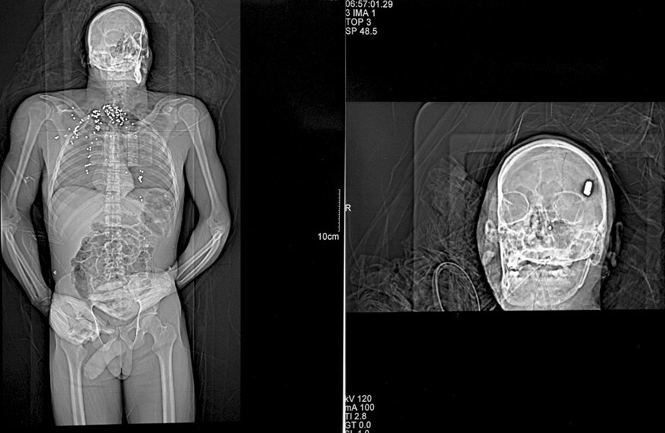 X-ray of a gunshot victim: shotgun to the chest, bullet to the head. Detroit, Michigan.